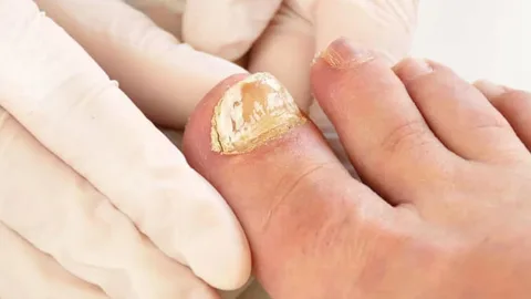 What’s The Best Way To Treat Fungal Toenail Infections?